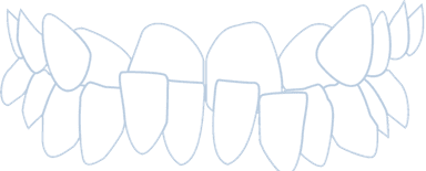 Underbite